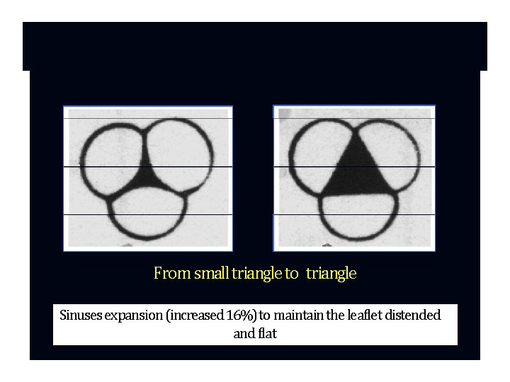 From small triangle to triangle Sinuses expansion (increased 16%) to maintain the leaflet distended