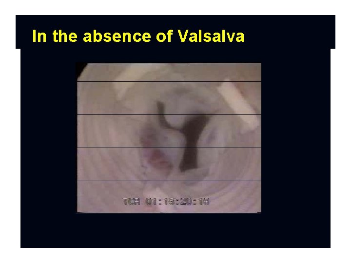 In the absence of Valsalva sinuses 