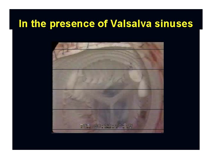 In the presence of Valsalva sinuses 