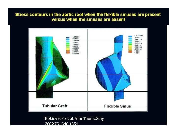 Stress contours in the aortic root when the flexible sinuses are present versus when