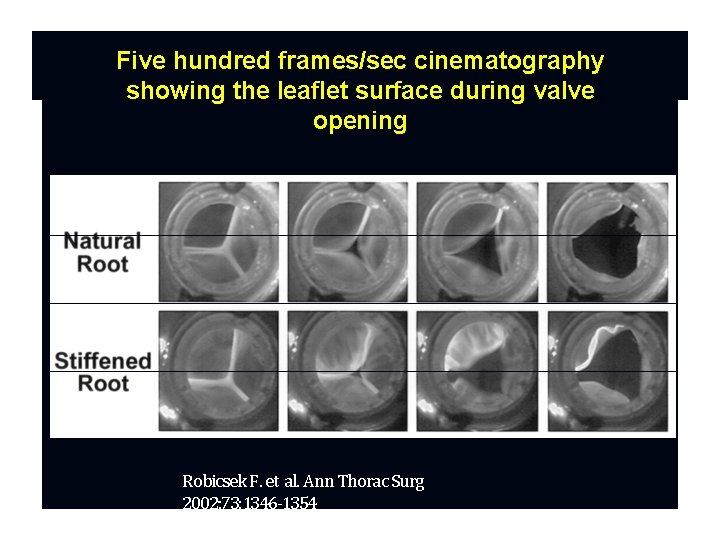 Five hundred frames/sec cinematography showing the leaflet surface during valve opening Robicsek F. et