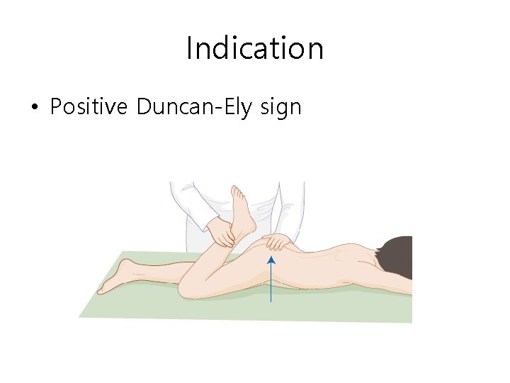 Indication • Positive Duncan-Ely sign 