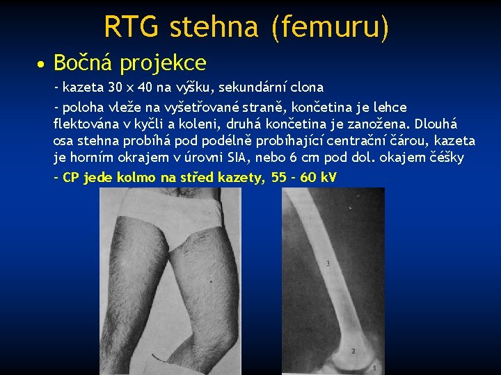 RTG stehna (femuru) • Bočná projekce - kazeta 30 x 40 na výšku, sekundární