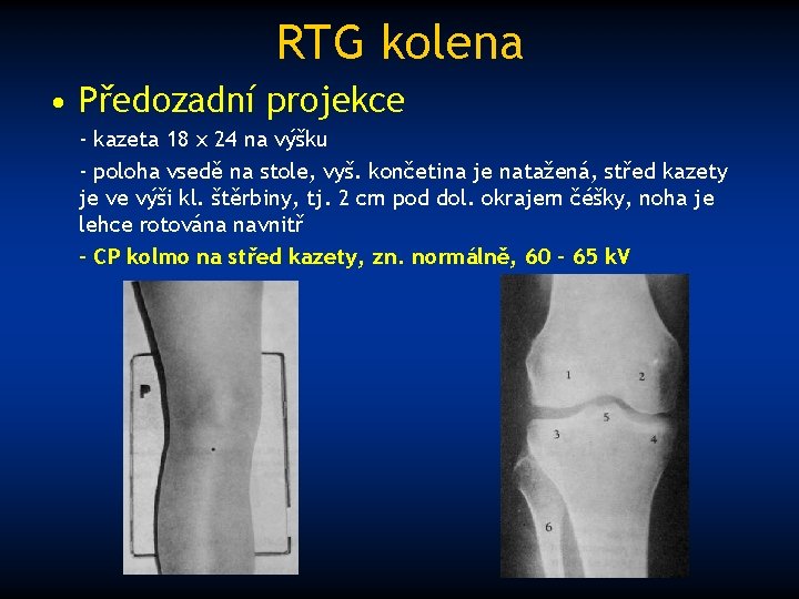 RTG kolena • Předozadní projekce - kazeta 18 x 24 na výšku - poloha