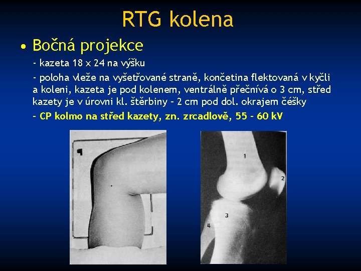 RTG kolena • Bočná projekce - kazeta 18 x 24 na výšku - poloha