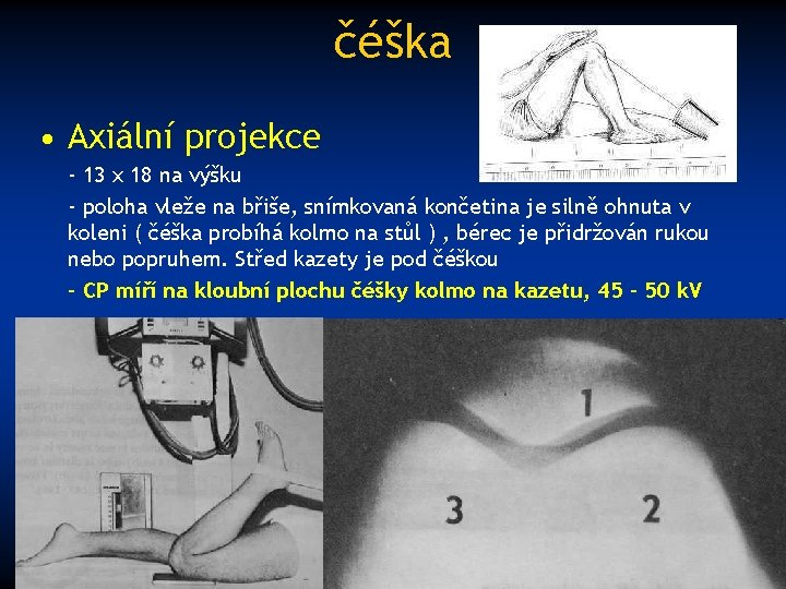 čéška • Axiální projekce - 13 x 18 na výšku - poloha vleže na