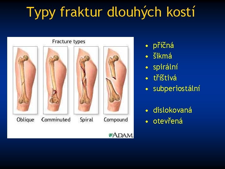 Typy fraktur dlouhých kostí • • • příčná šikmá spirální tříštivá subperiostální • dislokovaná