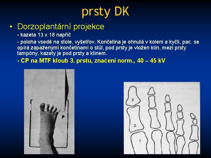 prsty DK • Dorzoplantární projekce - kazeta 13 x 18 napříč - poloha vsedě