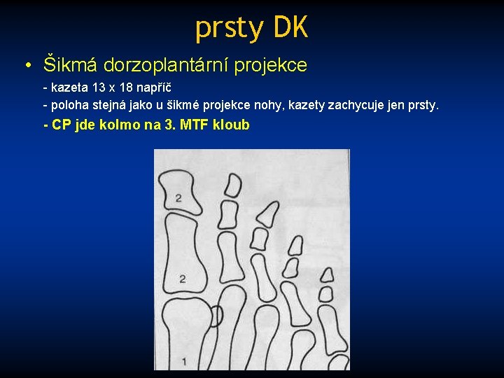 prsty DK • Šikmá dorzoplantární projekce - kazeta 13 x 18 napříč - poloha