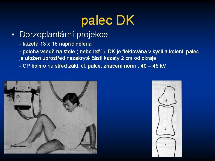 palec DK • Dorzoplantární projekce - kazeta 13 x 18 napříč dělená - poloha