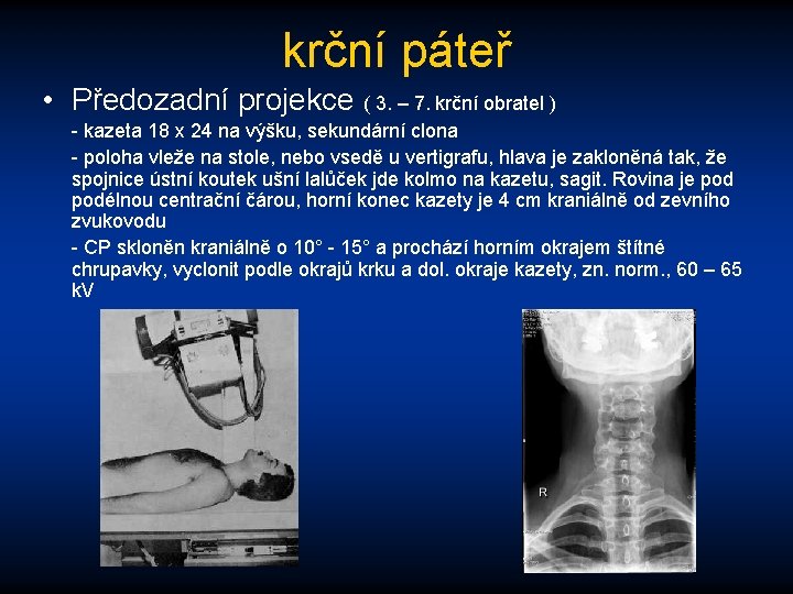 krční páteř • Předozadní projekce ( 3. – 7. krční obratel ) - kazeta