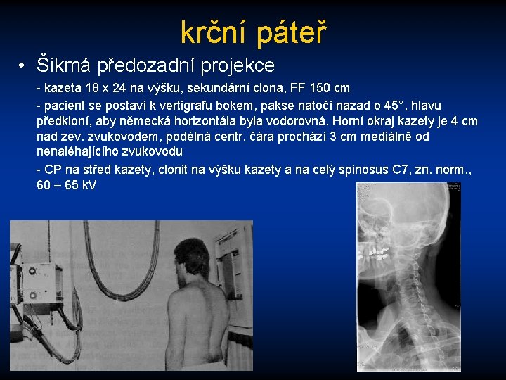 krční páteř • Šikmá předozadní projekce - kazeta 18 x 24 na výšku, sekundární