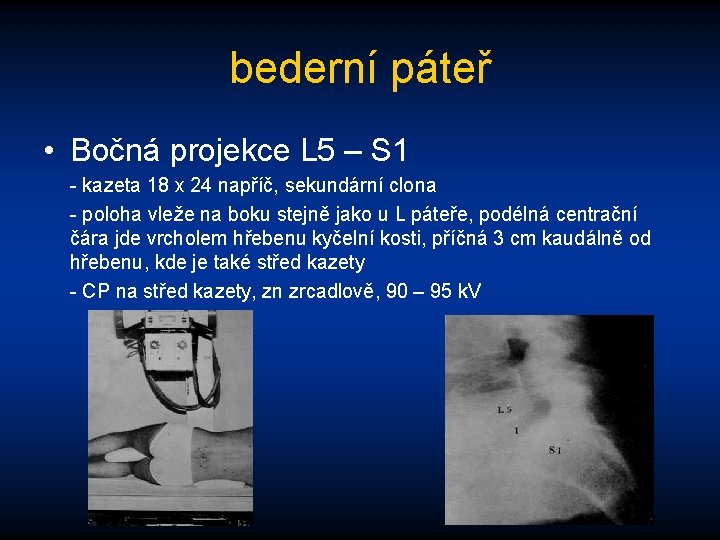 bederní páteř • Bočná projekce L 5 – S 1 - kazeta 18 x