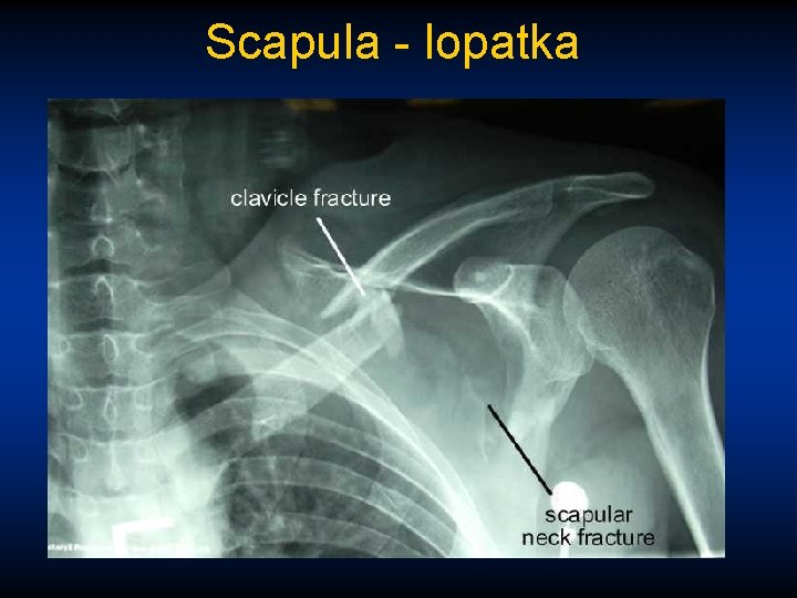 Scapula - lopatka 