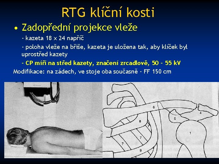 RTG klíční kosti • Zadopřední projekce vleže - kazeta 18 x 24 napříč -