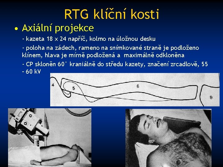 RTG klíční kosti • Axiální projekce - kazeta 18 x 24 napříč, kolmo na