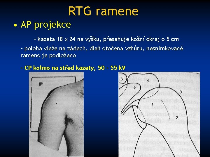 RTG ramene • AP projekce - kazeta 18 x 24 na výšku, přesahuje kožní