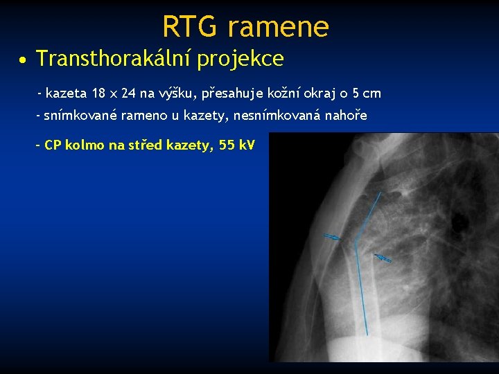 RTG ramene • Transthorakální projekce - kazeta 18 x 24 na výšku, přesahuje kožní