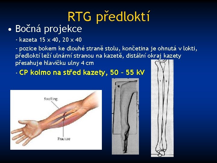 RTG předloktí • Bočná projekce - kazeta 15 x 40, 20 x 40 -