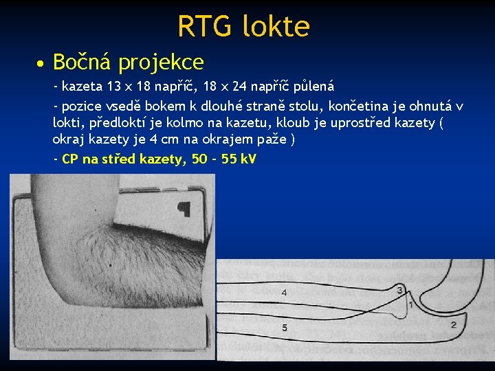 RTG lokte • Bočná projekce - kazeta 13 x 18 napříč, 18 x 24