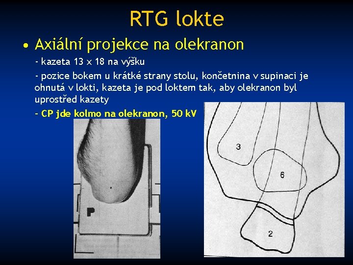 RTG lokte • Axiální projekce na olekranon - kazeta 13 x 18 na výšku
