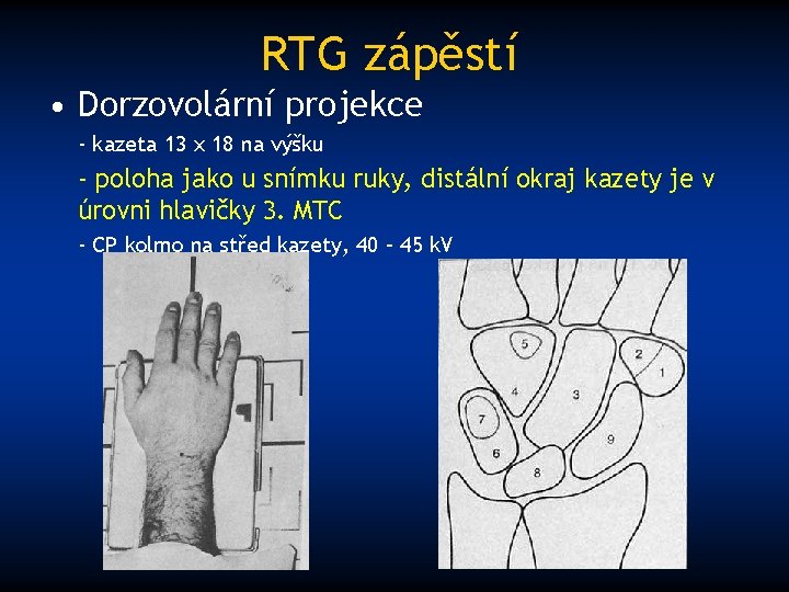 RTG zápěstí • Dorzovolární projekce - kazeta 13 x 18 na výšku - poloha