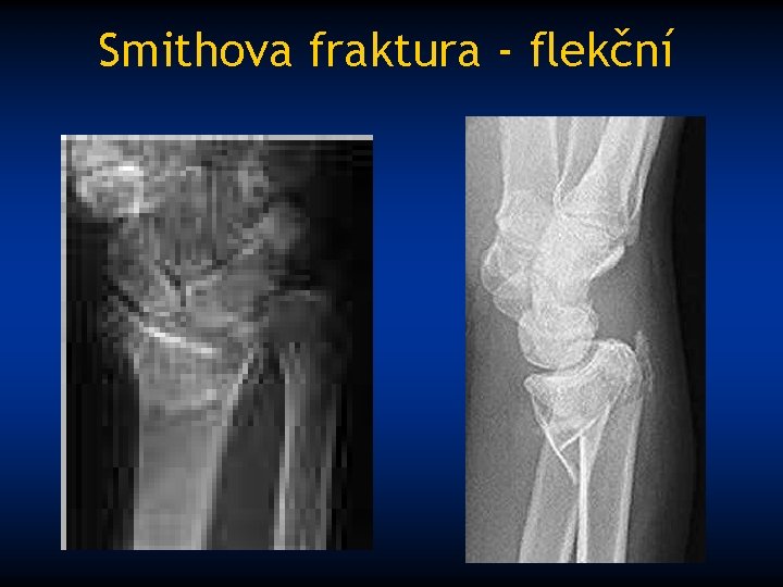 Smithova fraktura - flekční 