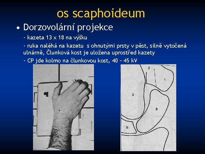 os scaphoideum • Dorzovolární projekce - kazeta 13 x 18 na výšku - ruka