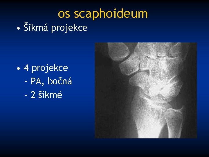 os scaphoideum • Šikmá projekce • 4 projekce - PA, bočná - 2 šikmé