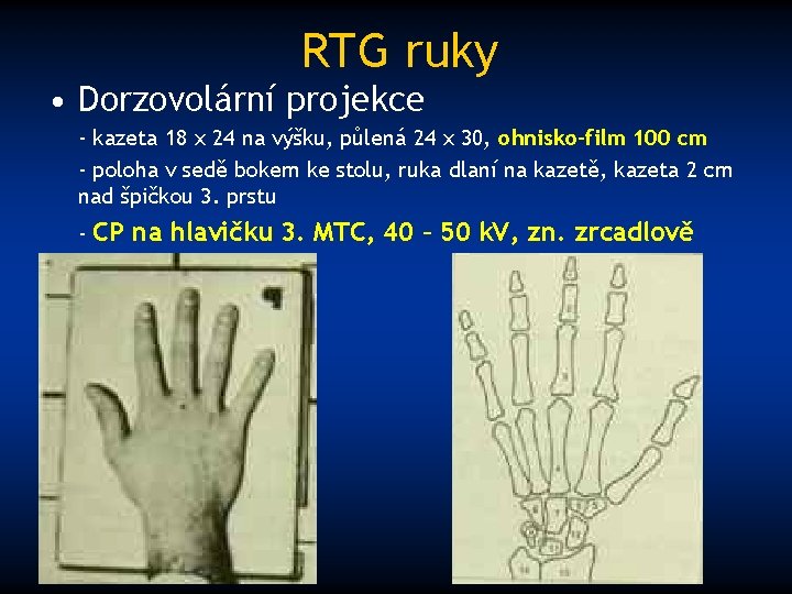 RTG ruky • Dorzovolární projekce - kazeta 18 x 24 na výšku, půlená 24