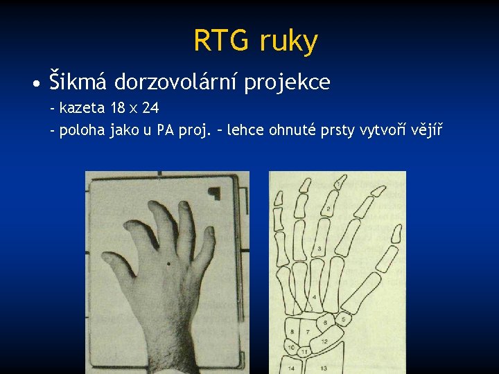 RTG ruky • Šikmá dorzovolární projekce - kazeta 18 x 24 - poloha jako