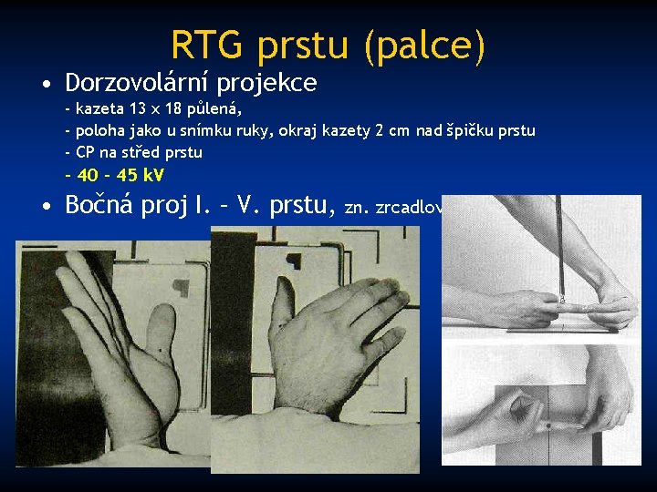 RTG prstu (palce) • Dorzovolární projekce - kazeta 13 x 18 půlená, - poloha