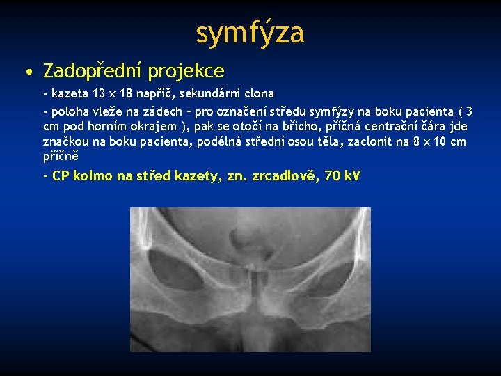 symfýza • Zadopřední projekce - kazeta 13 x 18 napříč, sekundární clona - poloha