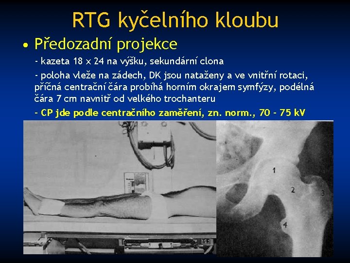 RTG kyčelního kloubu • Předozadní projekce - kazeta 18 x 24 na výšku, sekundární