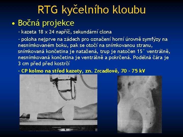 RTG kyčelního kloubu • Bočná projekce - kazeta 18 x 24 napříč, sekundární clona