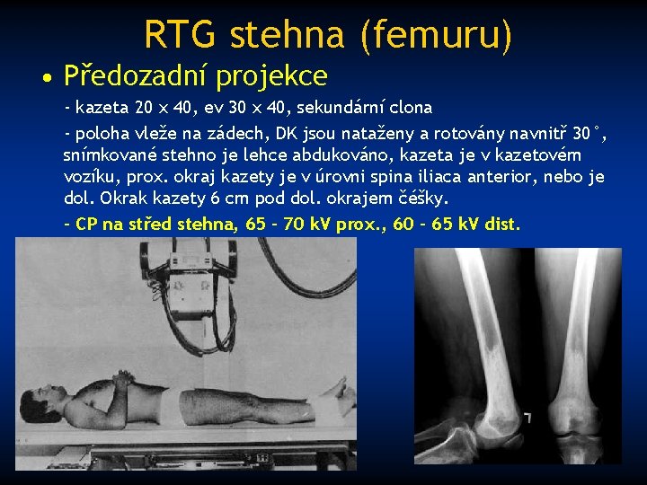 RTG stehna (femuru) • Předozadní projekce - kazeta 20 x 40, ev 30 x