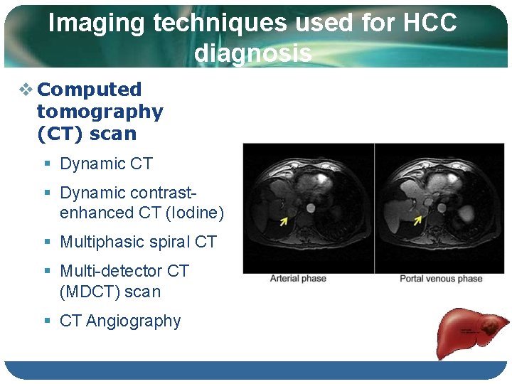 Imaging techniques used for HCC diagnosis Computed tomography (CT) scan Dynamic CT Dynamic contrastenhanced