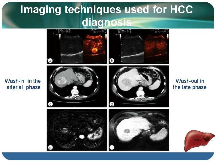 Imaging techniques used for HCC diagnosis Wash-in in the arterial phase Wash-out in the