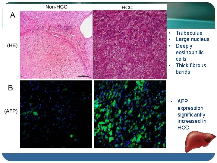 Confirmation Test Biopsy is the definitive diagnosis • Trabeculae • Large nucleus • Deeply