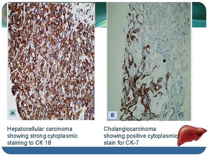 B Hepatocellular carcinoma showing strong cytoplasmic staining to CK 18 Cholangiocarcinoma showing positive cytoplasmic