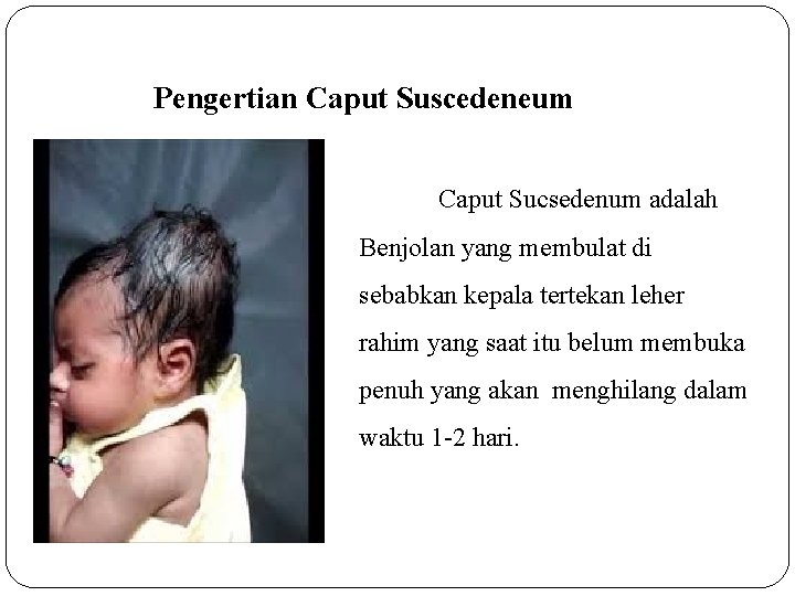 Pengertian Caput Suscedeneum Caput Sucsedenum adalah Benjolan yang membulat di sebabkan kepala tertekan leher