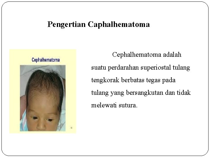 Pengertian Caphalhematoma Cephalhematoma adalah suatu perdarahan superiostal tulang tengkorak berbatas tegas pada tulang yang