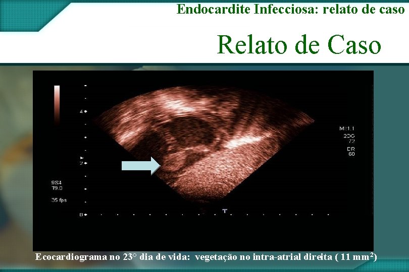 Endocardite Infecciosa: relato de caso Relato de Caso Ecocardiograma no 23° dia de vida: