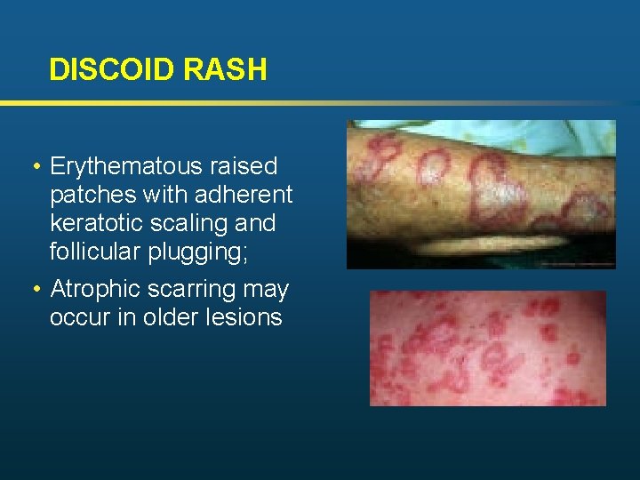 DISCOID RASH • Erythematous raised patches with adherent keratotic scaling and follicular plugging; •