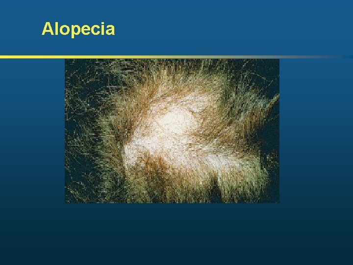 Alopecia 