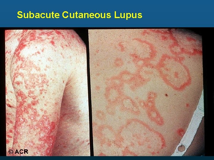 Subacute Cutaneous Lupus 