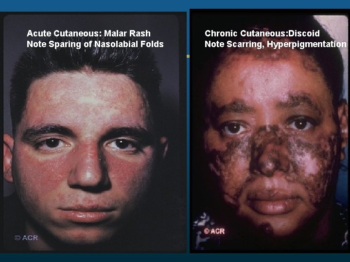 Acute Cutaneous: Malar Rash Note Sparing of Nasolabial Folds Chronic Cutaneous: Discoid Note Scarring,