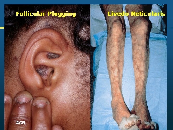 Follicular Plugging ACR Livedo Reticularis 