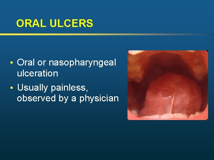 ORAL ULCERS • Oral or nasopharyngeal ulceration • Usually painless, observed by a physician