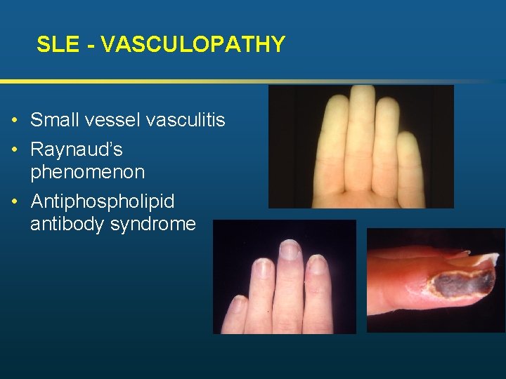SLE - VASCULOPATHY • Small vessel vasculitis • Raynaud’s phenomenon • Antiphospholipid antibody syndrome